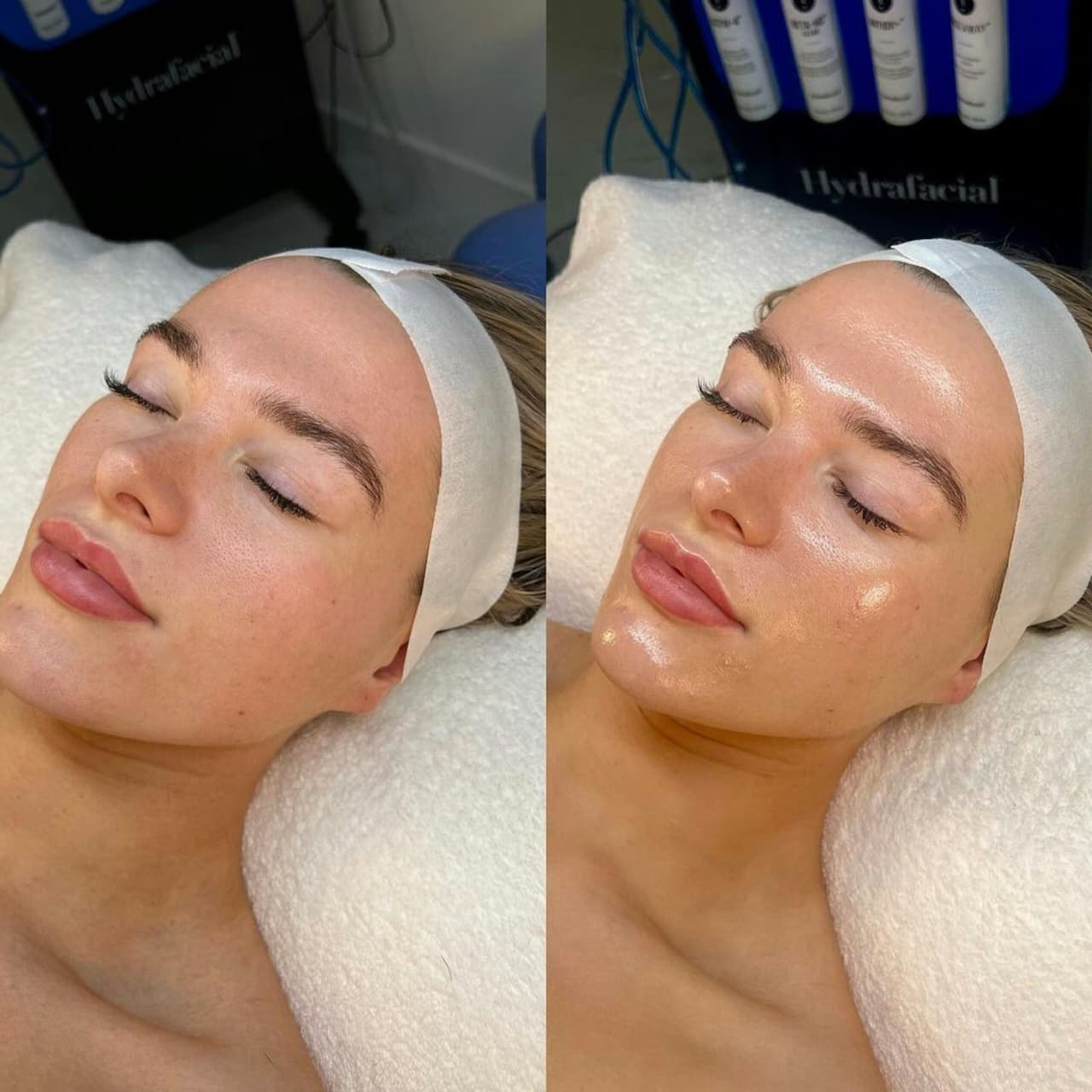 HydraFacial Behandlung vorher nachher bei Roxana Beauty Bar München