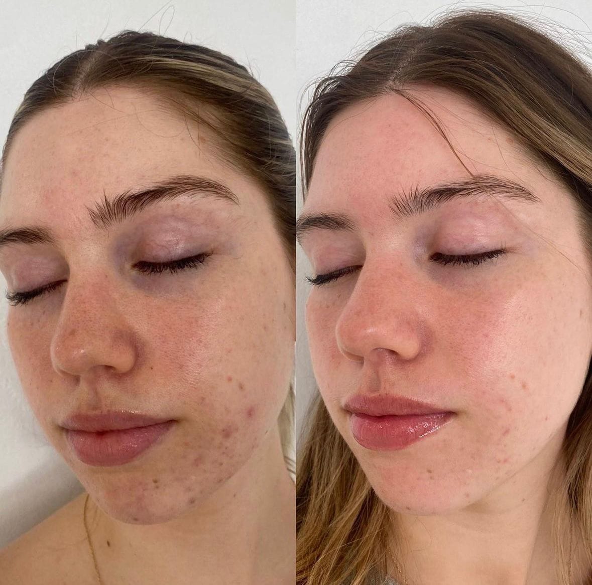 Gesichtsbehandlung vorher nachher bei Roxana Beauty Bar München